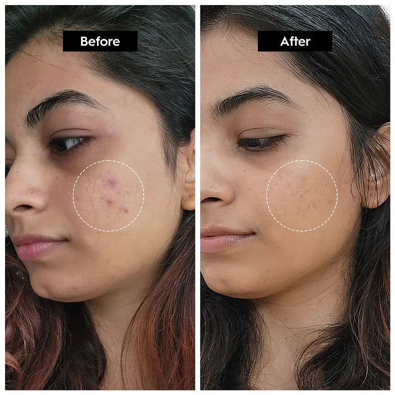 The Ordinary Niacinamide 10% + Zinc 1% Serum - 30ml