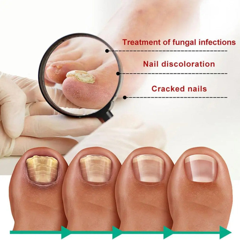 Nail fungus remover