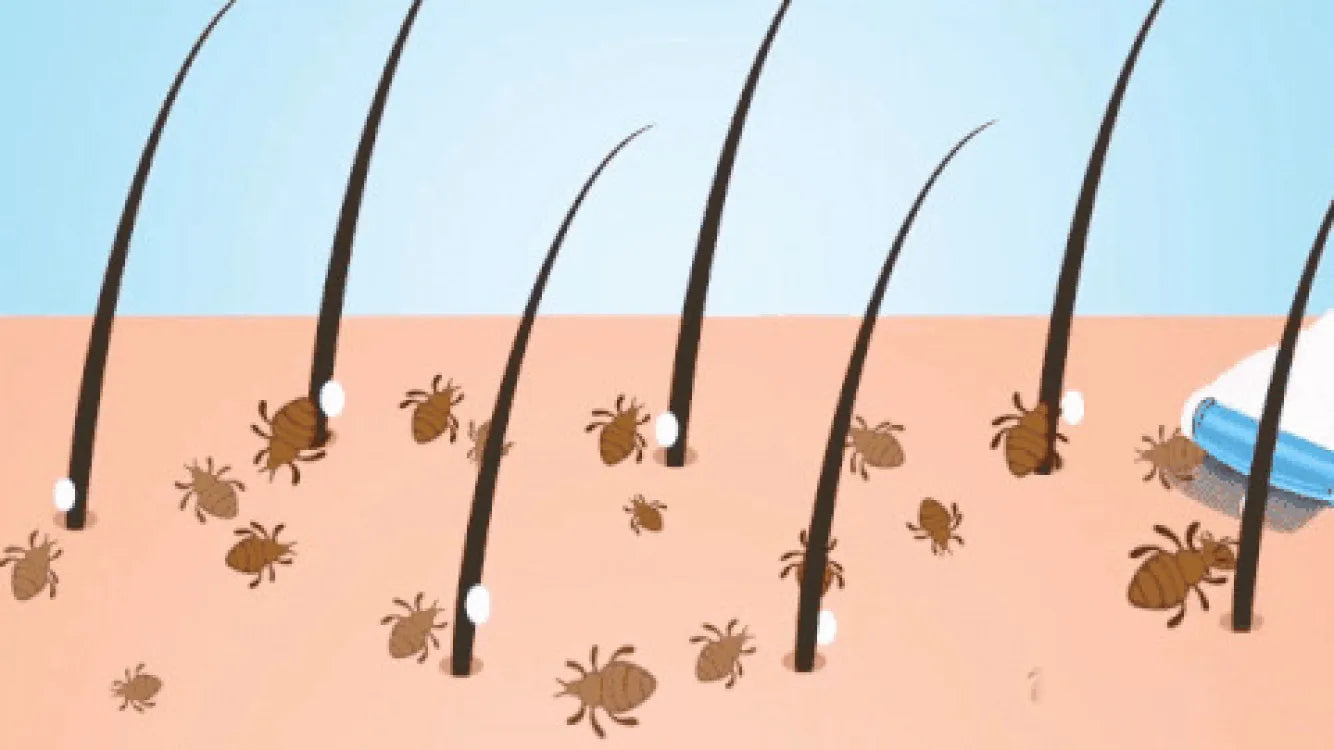 V- Comb Anti Lice