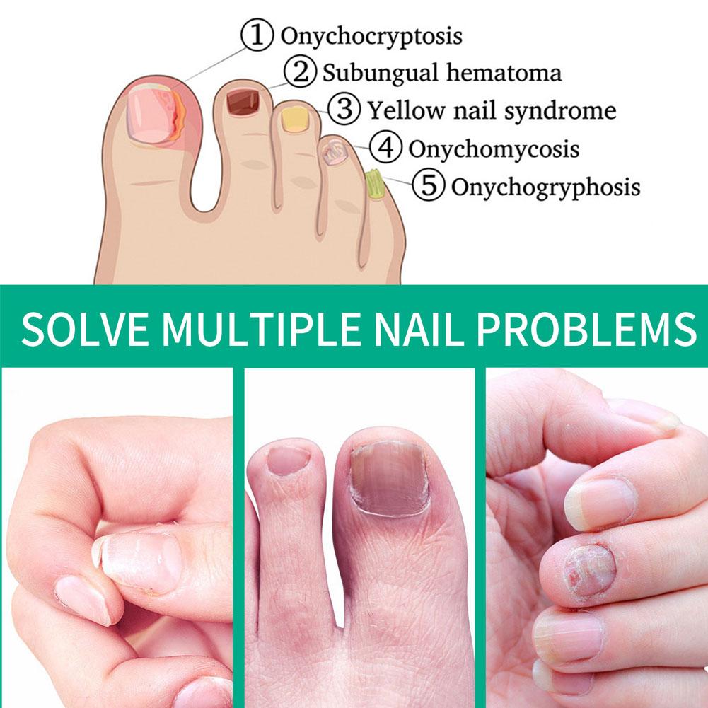 Nail fungus remover