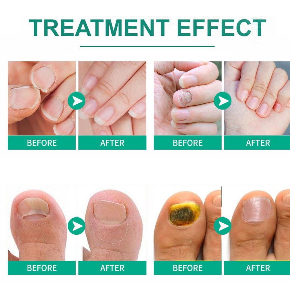 Nail fungus remover