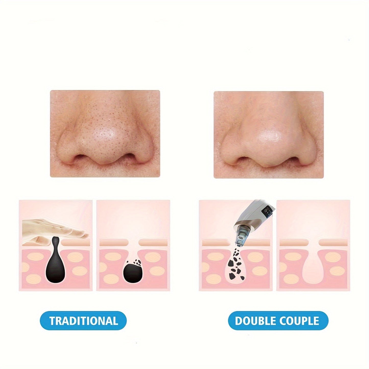 4 in 1 BlackHead Remover 8030