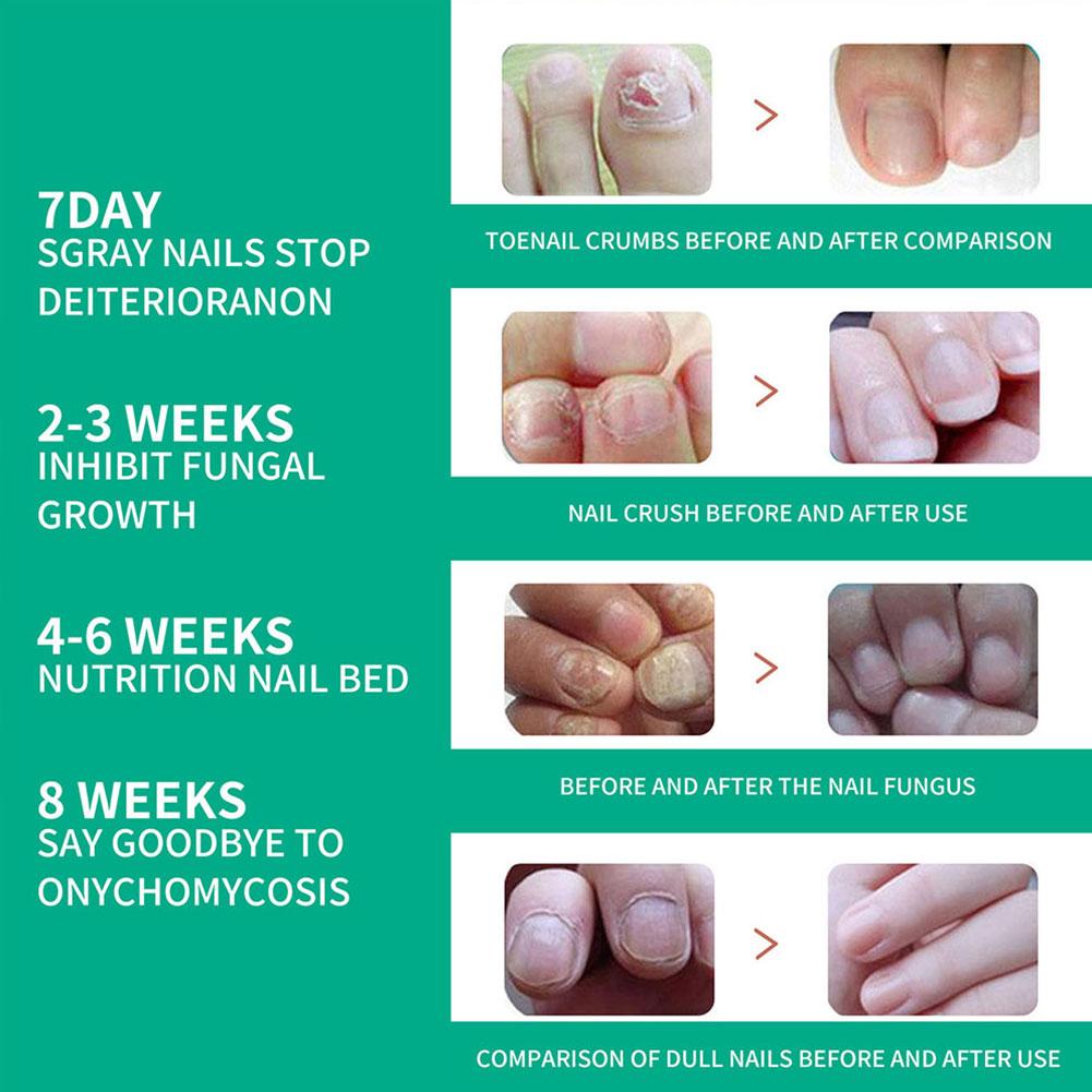 Nail fungus remover