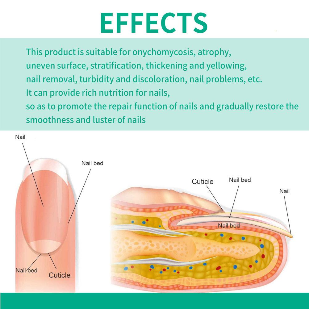 Nail fungus remover